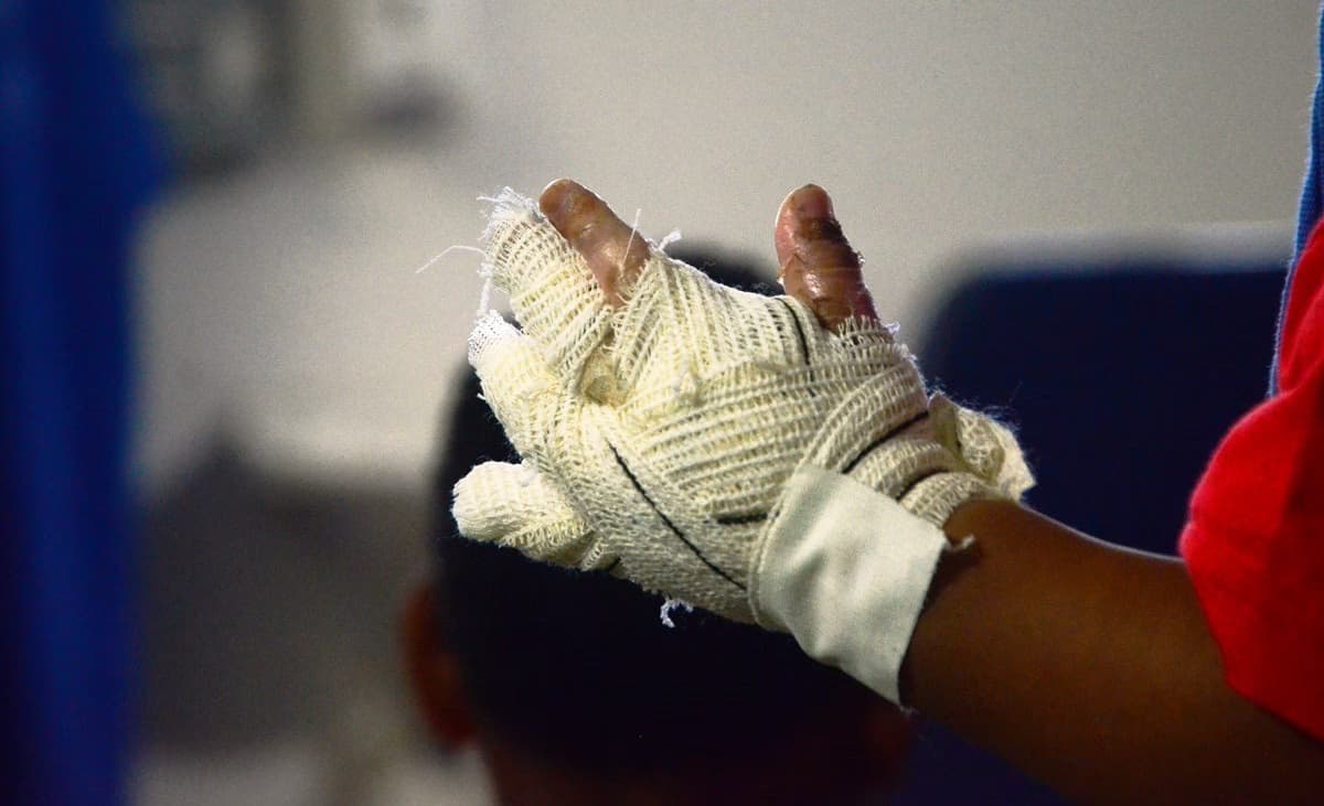 Uso incorreto de fogos de artifício pode provocar queimaduras graves e colocar a saúde em risco